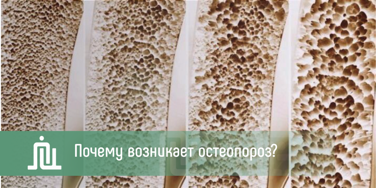 Почему возникает остеопороз?